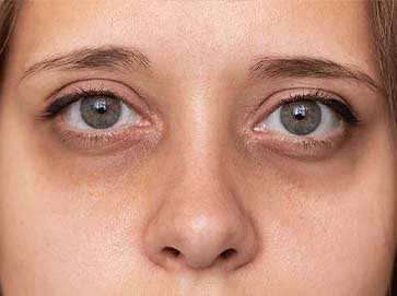 UNDER EYE DARK CIRCLES